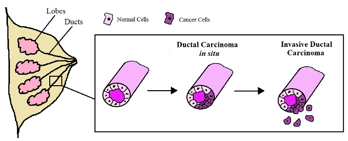 Ductal Carcinoma In Situ - Hình ảnh minh họa